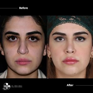 Before And After Natural Looking Rhinoplasty
