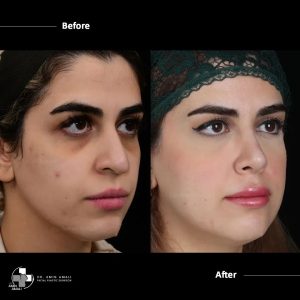 Before And After Natural Looking Rhinoplasty