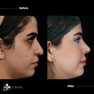 Before And After Natural Looking Rhinoplasty