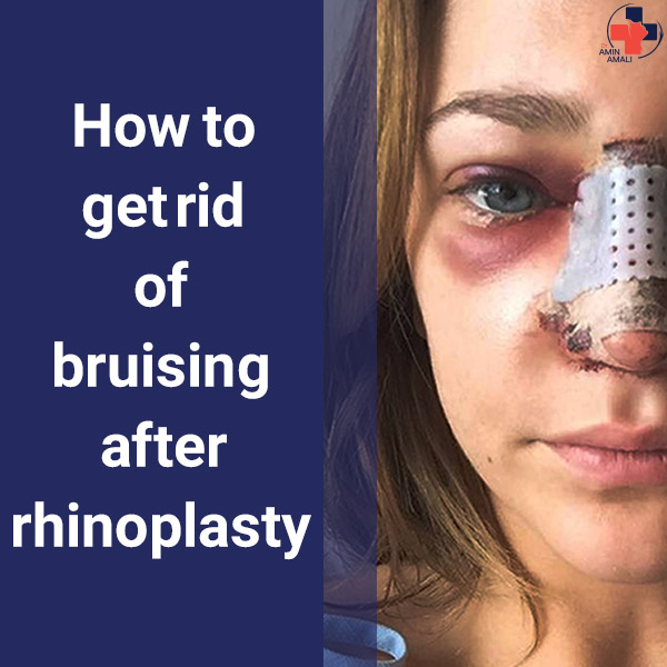 Bruising After rhinoplasty