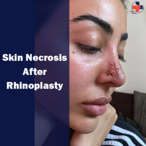 Skin Necrosis After Rhinoplasty
